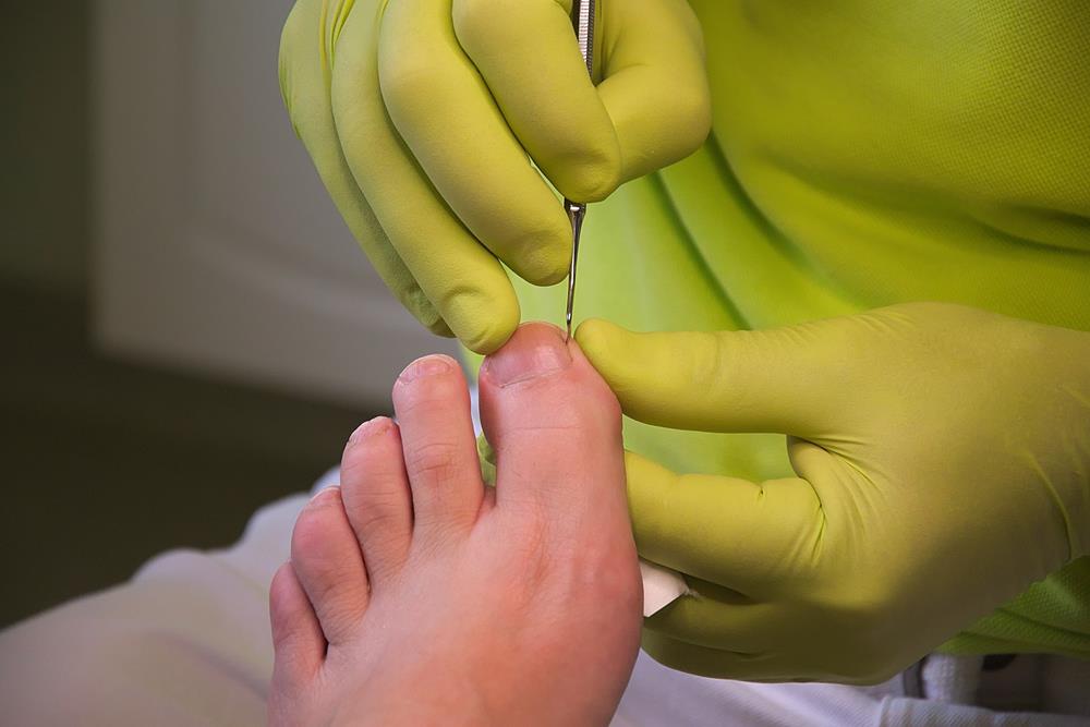 Podiatry Ingrown Toenails in Littleton, CO | Red Rocks Foot  Ankle Center